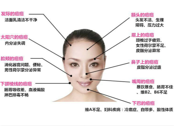 原來這些因素會導致長痘痘!你知道嗎? 原來這些因素會導致長痘痘!你知道嗎?