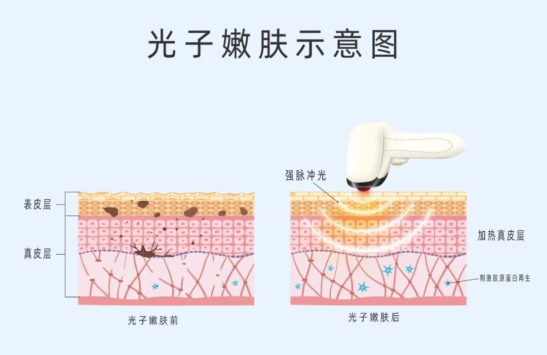 做好術后修復，拒絕“無效醫(yī)美”